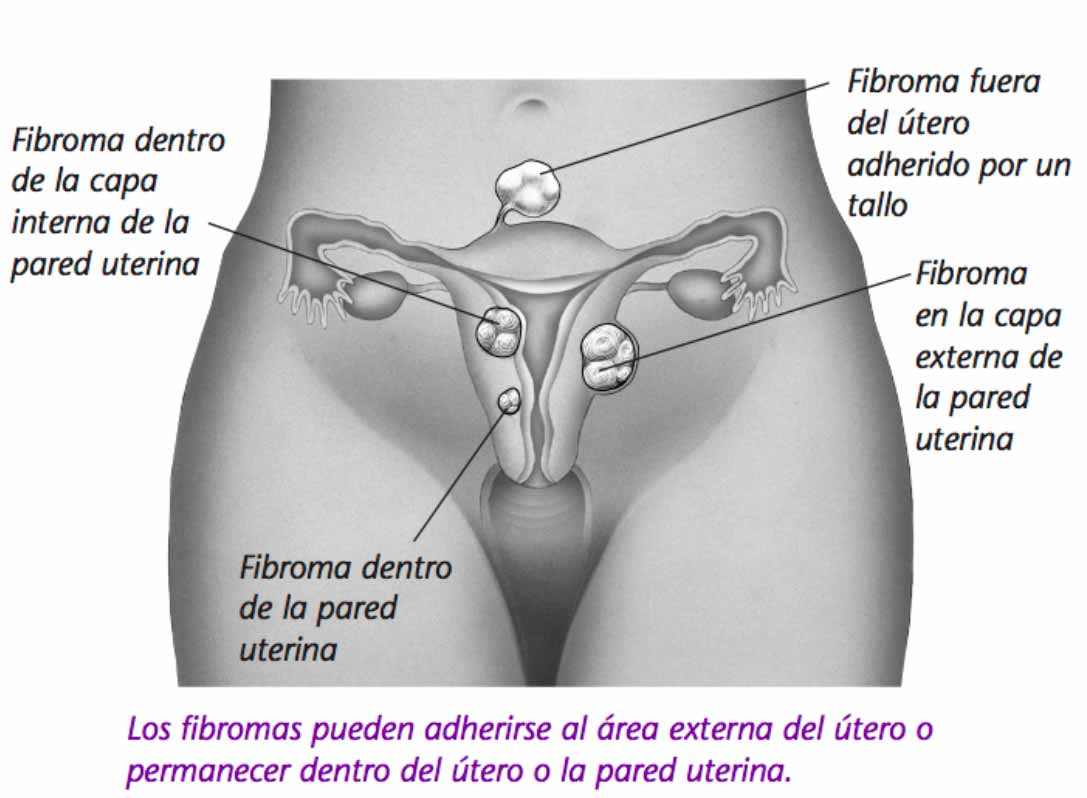 Miomas Uterinos Fibromas Uterinos Miomatosis Uterina Ginecologia Y