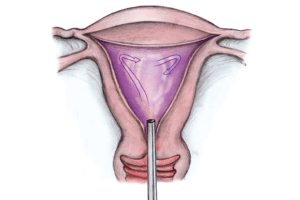 imagen de ablación endometrial por histerescopia - Ginecologia y obstetricia en bogota - ginecologa silvia plata