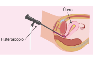 imagen articulos de ginecologia y obstetrica Biopsia de endometrio dirigida por histeroscopia ginecologa silvia plata - ginecologia y obstetricia en bogota