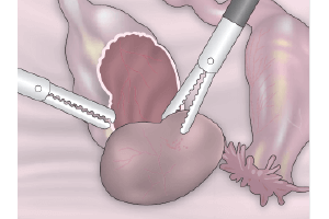 imagen de articulo de ginecologia y obstetricia sobre cistectomia de ovario por laparoscopia - ovario poliquístico - Ginecologa Silvia Plata