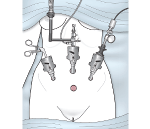 imagen de articulos de ginecologia y obstetricia sobre histerectomía por laparoscopia - ginecologa silvia plata