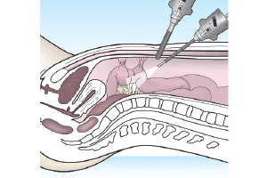 imagen de articulos de ginecologia y obstetricia sobre laparoscopia diagnostica Ginecologa Silvia Plata