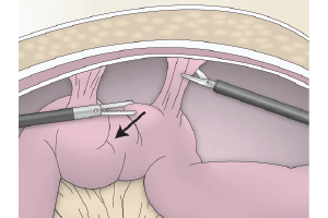 imagen de liberacion de adherencias peritoneales por laparoscopia miomectomia histeroscopica Ginecologia y obstetricia en bogota - Ginecologa Silvia Plata