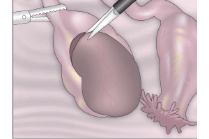 Imagen articulos de ginecologia y obstetricia sobre Manejo de Endometriosis por laparoscopia - Cáncer endometrial -Ginecologa Silvia Plata