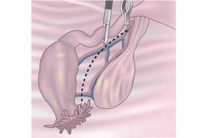 imagen recanalización tubárica ginecologa silvia plata - Ginecologia y obstetricia en bogota