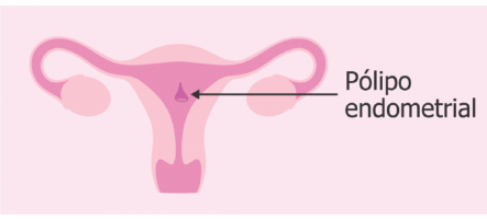 imagen de Remocion de pólipos endocervicales y endometriales ginecologa silvia - Ginecologia y obstetricia en bogota