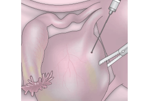 Imagen dearticulos de ginecologia y obstetricia sobre reseccion de Tumor de Ovario en patologia benigna - cáncer ovárico - Ginecologa Silvia Plata