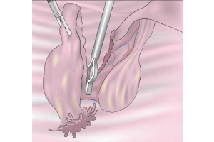 imagen de imagen Salpingo – Ooforectomía - Ginecologia y obstetricia en bogota - Ginecologa Silvia Plata