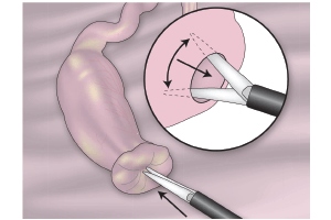 Imagen de fimbrioplastia Ginecologia y obstetricia en bogota - Ginecologa Silvia Plata