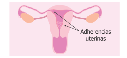 imagen de articulos de ginecologia y obstetricia sobre miomas uterinos- ginecologa silvia plata