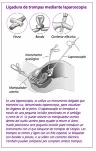 imagen de Esterilización Femenina - Ligadura de trompas por laparoscopia - Ginecologia y obstetricia en bogota - Ginecologa Silvia Plata