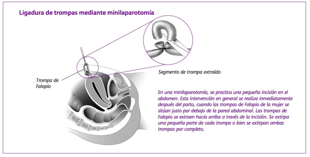 imagen de Esterilización Femenina - ginecologia y obstetricia en bogota - Visita el ginecologo con la ginecologa Silvia Plata